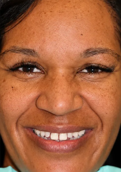 Ms. Monica's smile before treatment